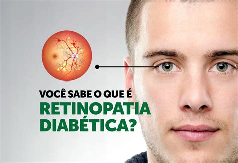 Voc Sabe O Que Retinopatia Diab Tica Hospital Santa Virg Nia