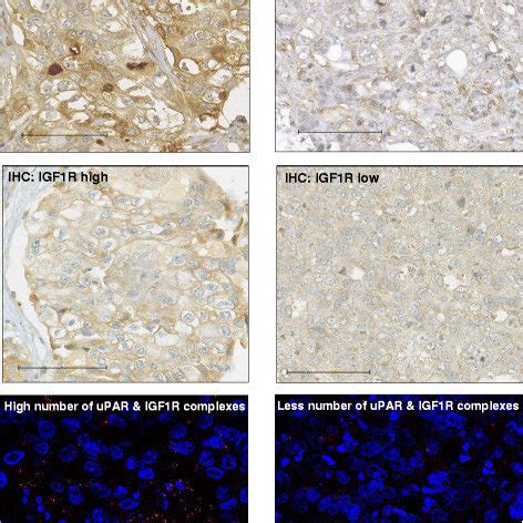 The Upar And Igf R Complexes Correlate With Their Co Overexpression In