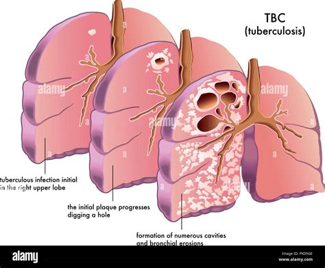 Vector Medical Illustration Of The Symptoms Of Tuberculosis Stock