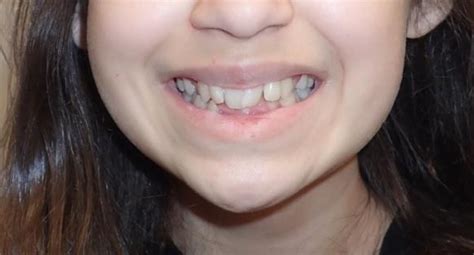 Crooked Teeth: Before and After