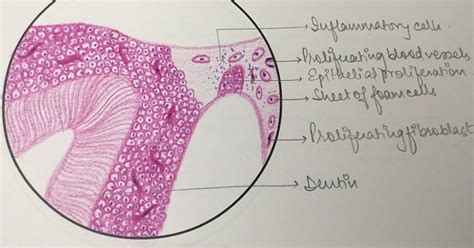 Illustrations: Periapical Granuloma - Oral Pathology