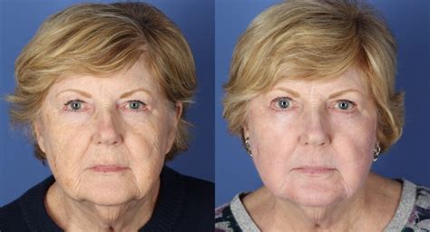 Erbium Laser Resurfacing In Naperville Il At Ccls