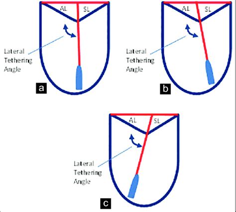 A In The Normal Heart The Lateral Tethering Angle At End Systole Is Download Scientific