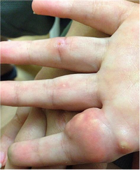 Calcinosis In Juvenile Dermatomyositis Updates On Pathogenesis And