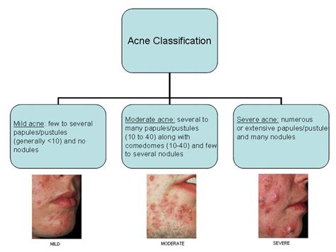 Acne In Teens Learn Pediatrics