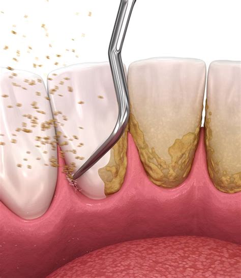 Scaling And Root Planing Panama City Gum Disease Therapy Dentist