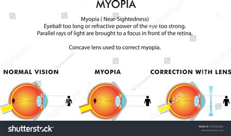 Myopia Vision Disorders Astigmatism Hyperopia Stock Vector Royalty