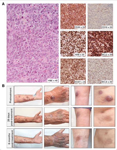 A Histology And Immunohistochemistry From Tumor Biopsy Showing A