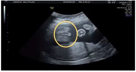 Diagnostics Free Full Text Ultrasonographic Diagnosis Of Fetal