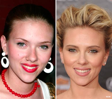 Scarlett Johansson Before And After Plastic Surgery