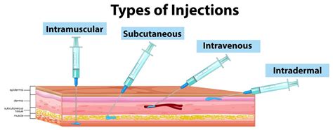 Types Of Injections Diagram 433025 Vector Art At Vecteezy