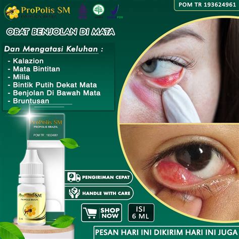 Jual Obat Mata Kalazion Benjolan Di Mata Bagian Luar Salep Mata