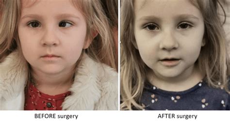 Strabismus Surgery Recovery Eyesmattermost