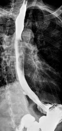 Small Oesophageal Diverticulum Radiology Case Radiopaedia Org