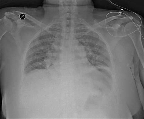 Anteroposterior Chest X Ray With Elevated Left Hemidiaphragm And