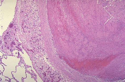 Pathology Outlines Infarct Pulmonary Emboli