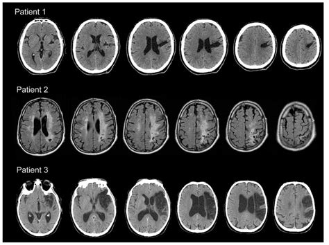 Top Consecutive Slices Of Ct Scans For Patient 1 Illustrating Right Download Scientific