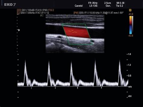 Ultrasound images • Common carotid artery, CFM & PW, echogramm №491