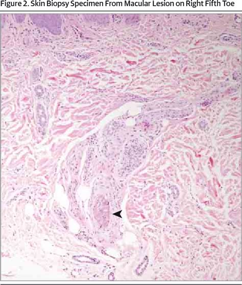 Figure 1 From Janeway Lesions And Splinter Hemorrhages In A Patient With Eosinophilic