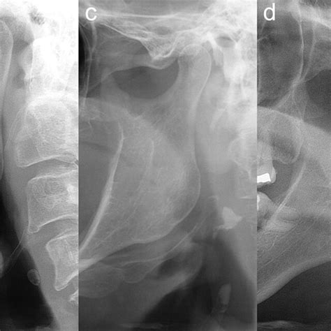 Representation Of The Soft Tissue Calcifications Evaluated In The