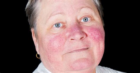 Facial Rash Around Nose Telegraph