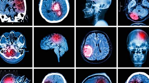 Aula Gratuita Hemorragias Intracranianas