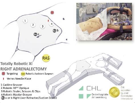 Patient And Trocar Positioning For A Right Lateral Transabdominal