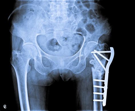 X Ray De La Pelvis Con El Hueso Del Fémur De La Fractura Foto De