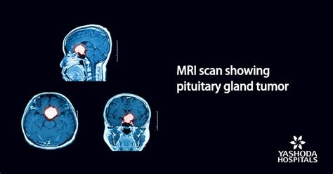 Pituitary Gland Tumors Important Things To Know About