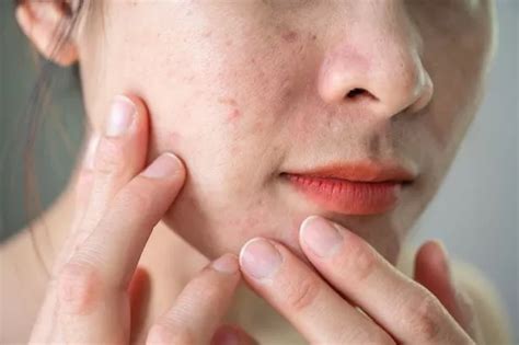 LloydsPharmacy Online Doctor Explains Why Acne Is Worse In Winter And