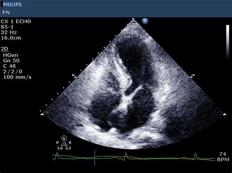 Takotsubo Cardiomyopathy A Clinical Update For The Cardiovascular