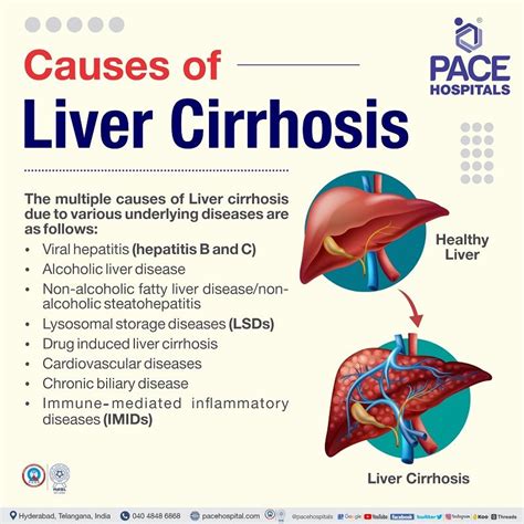 Liver Cirrhosis Symptoms Causes Complications And Prevention