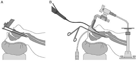 The Difference In The Surgical Field Between The A Direct Download Scientific Diagram