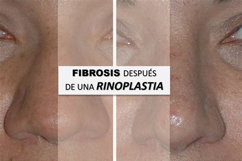 Conoces La Fibrosis Tras Una Rinoplastia Cirugia Plastica Miami