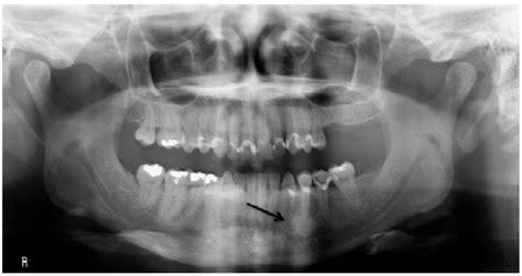 Bony Lesions Intechopen