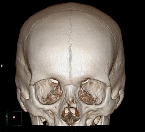 Persistent Metopic Suture Is A Rare But Important Variant To Recognise