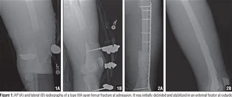 Figure 1 From Staged Bone Grafting Following Placement Of An Antibiotic