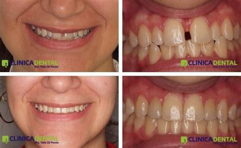 Invisalign Antes y después Fotos reales de ortodoncia invisible