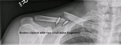 Clavicle Fractures Dr Michael Codsi Patient Education Michael