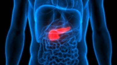 Pancreatic cancer may be able to be detected in stool samples, study ...