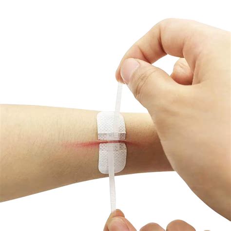 Wound Quick Suture Zipper Bandage New Type Of Painless Stitch Free