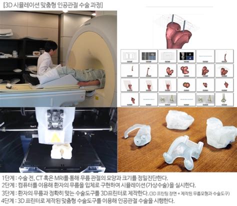 강남 연세사랑병원 인공관절 연구센터 환자 맞춤형 수술로 정확도 높혀