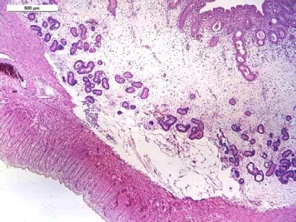 Histopathological Findings Of Uterus Endometrium Myometrium The