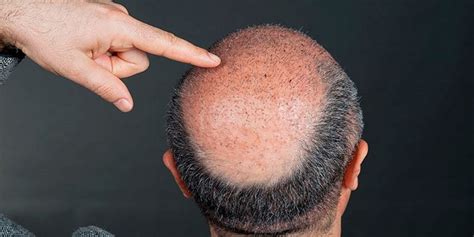 Fut Hair Transplant In Riyadh And Saudi Arabia Cost