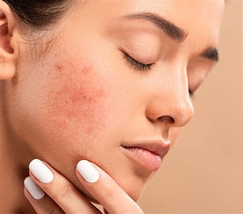 Acne Laser Skin Surgery Center CA Sacramento CA