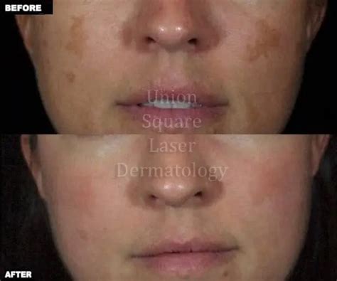 Melasma Utah Valley Dermatology