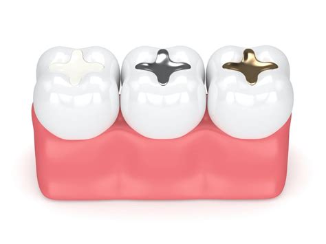 The Types of Dental Fillings | Dentists in Burlington NC