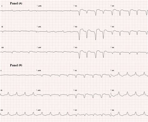 Panel A Ecg Showing New‐onset Atrial Fibrillation With Download Scientific Diagram