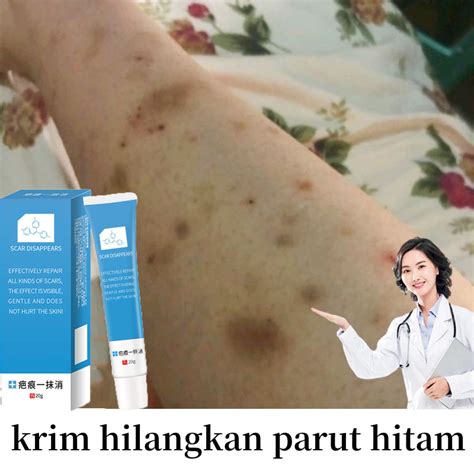 Krim Hilangkan Parut Hitam Menghilangkan Bekas Luka Lama Ubat Parut