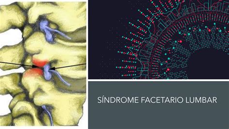 SOLUTION Síndrome facetario lumbar Fisiopatología y tratamiento